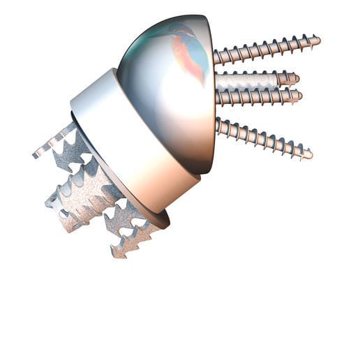 Inverse Humeruskopfprothese - EASYTECH® - FX Solutions - zementfrei