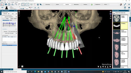 Software für Dentalimplantologie - NemoScan - Nemotec - für Kliniken / für Krankenhaus / Labor