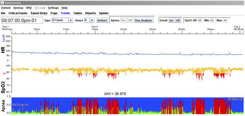 Test-Software - LX Sleep - NorthEast Monitoring - Aufzeichnung / Analyse / für Polysomnografie