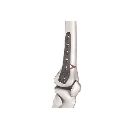 Osteotomieplatte für Oberschenkelknochen - 122532104 - Canwell Medical - distal / seitlich / mit Verriegelung