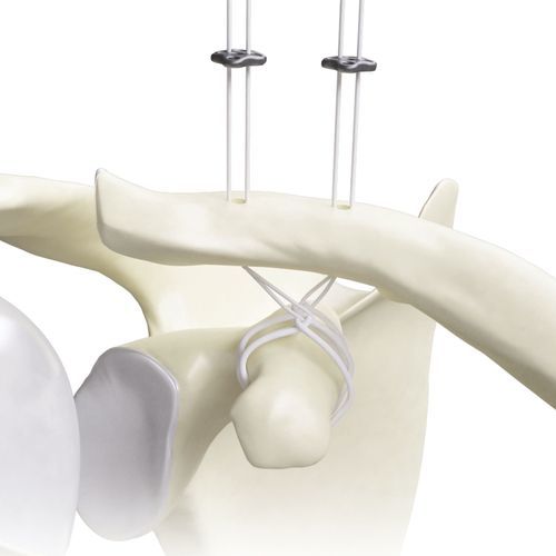 Button zur Rekonstitution des Akromio-Klavicular-Bandes - Diamond - Canwell Medical