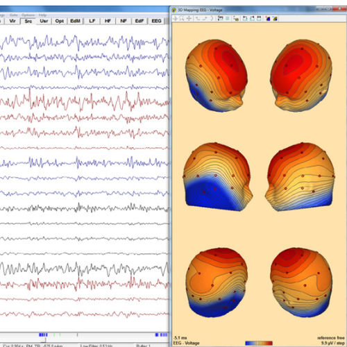 Analysesoftware - Research 7.1 - BESA GmbH - 3D-Visualisierung / Diagnose / Import