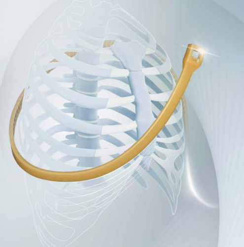 Cerclagekabel für Sternum-Verschluss - SternoEaZip® - Kontour Medical Technology - Monofilament-Polymer