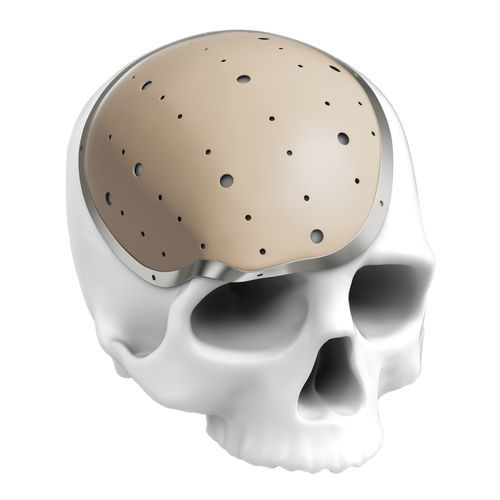 Patientenspezifisches Schädelimplantat - Kontour Medical Technology