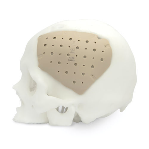 Patientenspezifisches Schädelimplantat - CranioPEEK3D ™ - Kontour Medical Technology