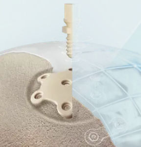 Patientenspezifisches Schädelimplantat - CranioLink&trade; - Kontour Medical Technology