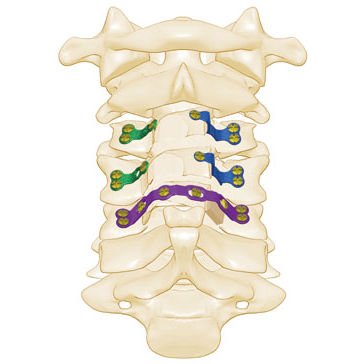 Laminoplastikplatte für Halswirbel - Rita - Shanghai Sanyou Medical - für Wirbel