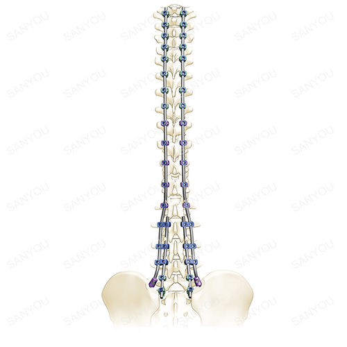 Stabilisierungssystem für Osteosynthese / Brust Lendenwirbelsäule und Kreuzbein - Adena - Shanghai Sanyou Medical - dorsaler Zugang / für Erwachsene