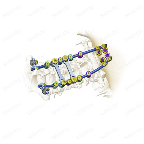 Okzipito-zervikales Stabilisierungssystem für Osteosynthese - Cervina® - Shanghai Sanyou Medical - dorsaler Zugang / für Erwachsene