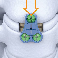 HWS-Zwischenwirbelimplantat - Carmen® - Shanghai Sanyou Medical - lateraler Zugang