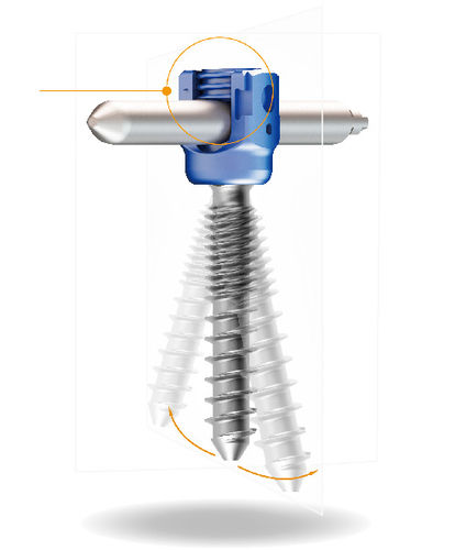 LWS-Pedikelschraube - Lora™ MIS - Shanghai Sanyou Medical - Thorax / kanüliert / Metall