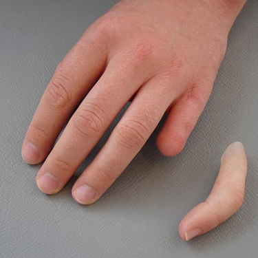 Kosmetische Fingerprothese - schubert and braun prothesenwerk - für Erwachsene