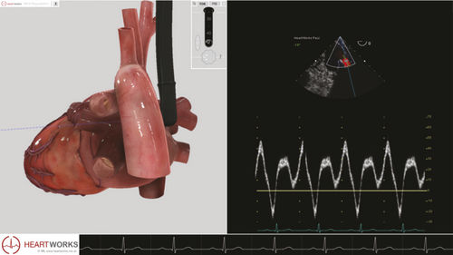 Software-Modul / für Echokardiographie - Pathology Module 3 - Inventive Medical Limited - Bewertung