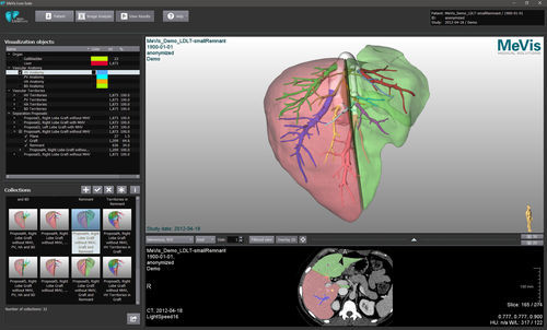 Bildanalyse-Software - MeVis  - VAREX Imaging - Visualisierung / Behandlungsplanung / Import