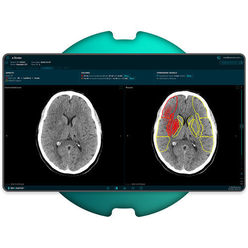 Software für Schlaganfalldiagnostik - e-Stroke - Brainomix - Bildanalyse / Visualisierung / Beschaffung
