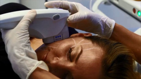 Ultraschallpeelinggerät - Ultherapy® - Merz Pharma - HIFU-Body-Contouring-Gerät / auf Wagen