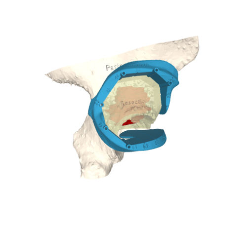 Hüftprothese Schneidschablone - 3D Side