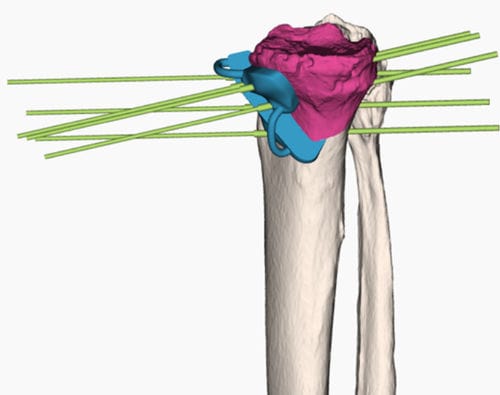Schneidschablone für Tibiaosteotomie - 3D Side