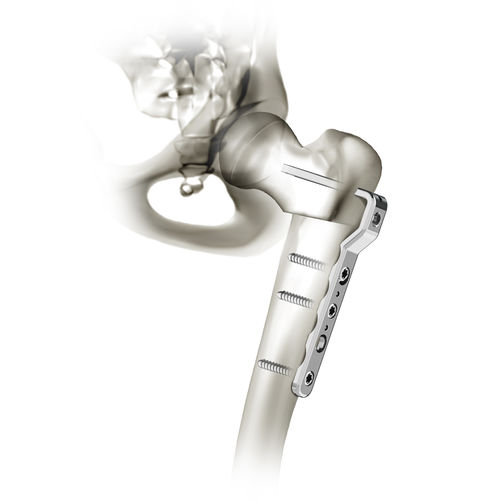 Kompressionsplatte für Oberschenkelknochen - 00-1200-2000 - OrthoPediatrics - proximal / distal / mit Verriegelung