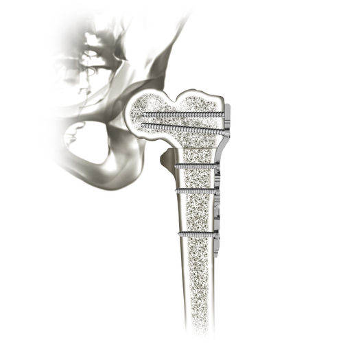 Kompressionsplatte für Oberschenkelknochen - 00-0907-0103 - OrthoPediatrics - proximal / mit Verriegelung / Metall