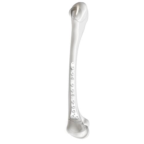 Kompressionsplatte für Oberschenkelknochen - PediLoc® - OrthoPediatrics - distal / seitlich / mit Verriegelung