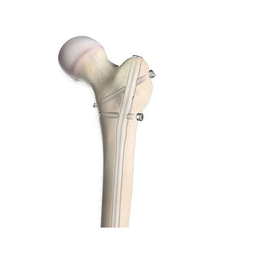 Marknagel für Oberschenkelknochen - 00-1501-0720 - OrthoPediatrics - mit proximaler Fixierung / mit distaler Fixierung / für Kinder
