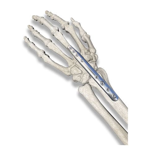 Arthrodeseplatte für Handgelenk - PediFrag  - OrthoPediatrics - Metall / für Kinder
