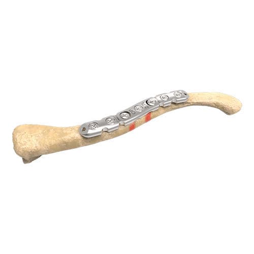 Kompressionsplatte für Schlüsselbein - 00-1005-5006 - OrthoPediatrics - medial / mit Verriegelung / Metall