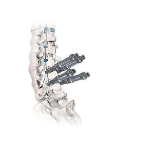 Thorako-lumbales Stabilisierungssystem für Osteosynthese - RESPONSE™ 4.5/5.0 - OrthoPediatrics - dorsaler Zugang / für Kinder
