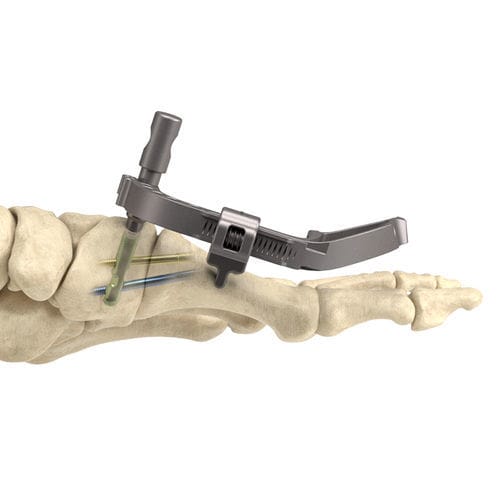 Arthrodeseschraube für tarsal-metatarsales Gelenk - InCore® - Nextremity Solutions - ohne Kopf