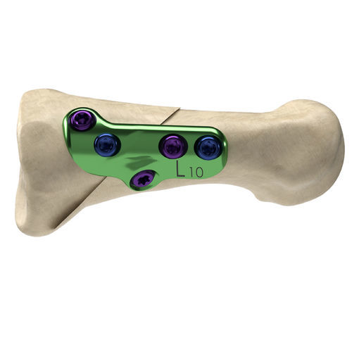 Osteotomieplatte für Hallux Valgus - Axi+Line® - Nextremity Solutions - für Metatarsalknochen / proximal / mit Verriegelung