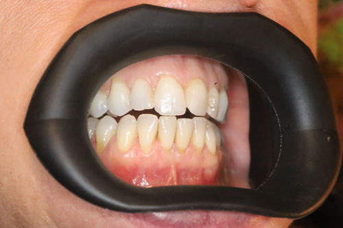Lippenretraktor - VisionButler™ - Gate Dental Services Ltd - Wangen / Dental / autoklavierbar