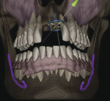 Anatomie-Software - IconiX  - X-Nav Technologies - Dental / für Chirurgie / Planung