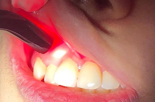 Dentalhandstück - Bio-Stimulation - Pioon Medical Laser - Laser / direkt / autoklavierbar