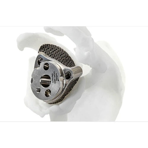Inverse Prothese für Cavitas glenoidalis - Glenius - Materialise UK - Revision / Erstbehandlung