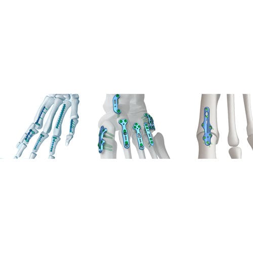Kompressionsplatte für Fingerglied - Irene Ortho - für tarsal-metatarsales Gelenk / mit Verriegelung / Metall