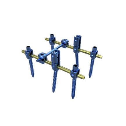 Thorako-lumbales Stabilisierungssystem für Osteosynthese - Irene Ortho - dorsaler Zugang / für Erwachsene