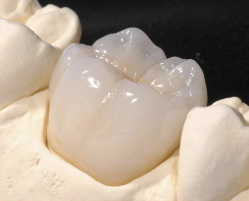 Zirkonoxid-Zahnkrone - CRYSTAL - Derby Dental - für Vorderzähne / für Seitenzähne