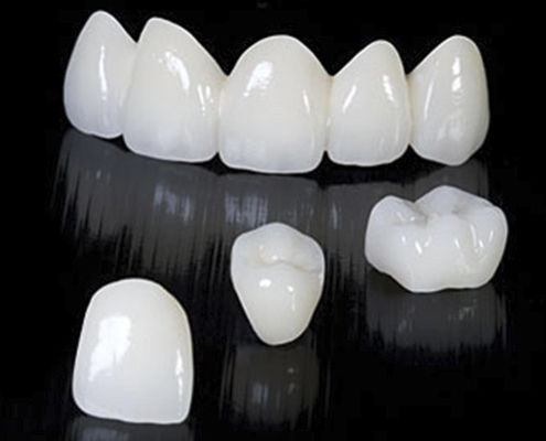 Zirkonoxid-Zahnbrücke - CRYSTAL - Derby Dental - für Vorderzähne
