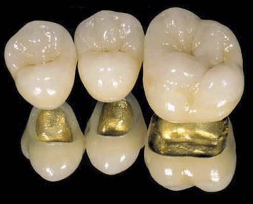 PFM-Zahnkrone - CLASSIC  - Derby Dental - für Vorderzähne / für Seitenzähne