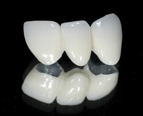 PFM-Zahnbrücke - CLASSIC  - Derby Dental - für Vorderzähne / für Seitenzähne