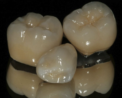 PFM-Zahnkrone - ECONOMY  - Derby Dental - für Vorderzähne / für Seitenzähne