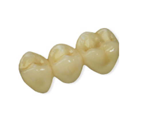 PMMA-Zahnbrücke - CAD Temp  - Derby Dental - für Vorderzähne / für Seitenzähne