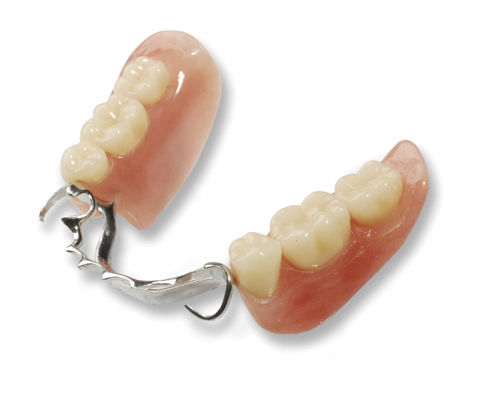 Zahnprothese für Vorderzähne - Cast Partial  - Derby Dental - für Seitenzähne