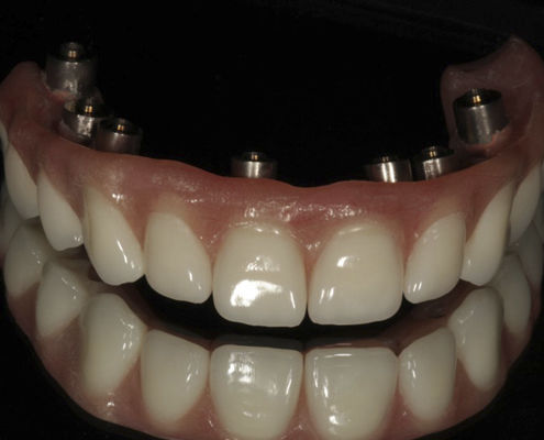 Acrylzahnprothese - Screw Retained  - Derby Dental - für Vorderzähne / für Seitenzähne
