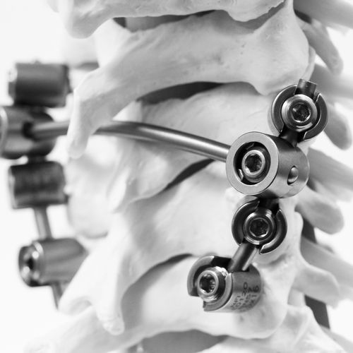 Stabilisierungssystem für Osteosynthese / HWS - KM BEBE - NEURO FRANCE Implants - dorsaler Zugang / für Erwachsene / für Kinder