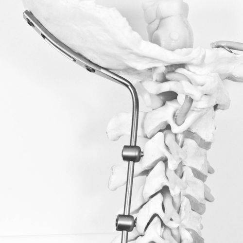 Okzipito-zervikales Stabilisierungssystem für Osteosynthese - J.O.C. - NEURO FRANCE Implants - dorsaler Zugang / für Erwachsene