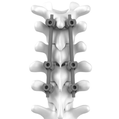 Zervikothorakales Stabilisierungssystem für Osteosynthese - C.T.J - NEURO FRANCE Implants - dorsaler Zugang / für Erwachsene