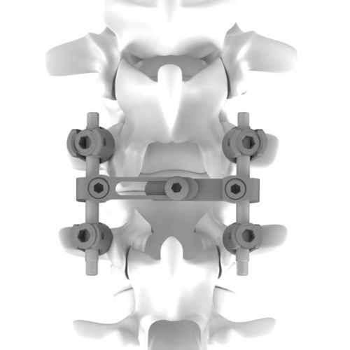 Thorako-lumbales Stabilisierungssystem für Osteosynthese - K.M. - NEURO FRANCE Implants - dorsaler Zugang / für Erwachsene