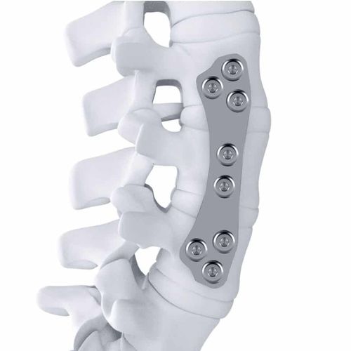 LWS-Arthrodeseplatte - ARTHEMIS - NEURO FRANCE Implants - thorako-lumbal / anterolateral / Titan